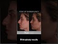 before and after rhinoplasty - Dr Guncel Ozturk #rhinoplastyturkey #drgo #beforeandafter  #nosejob