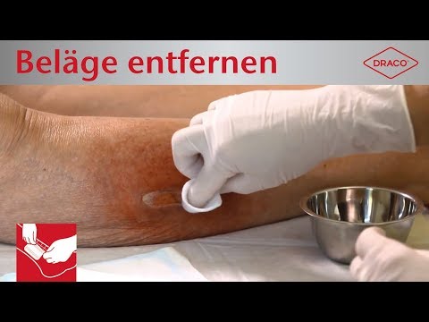 Video: Was bedeutet fibrinoeitrig?