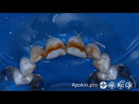 Video: Zobu Fluoroze - ārstēšana, Simptomi