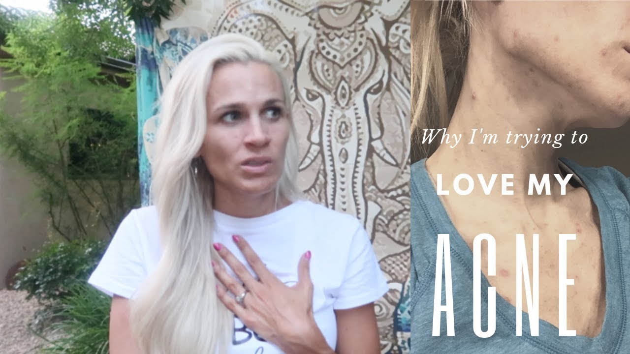 IMPERFECTIONS | Loving my acne flaws (Embracing your Imperfections)