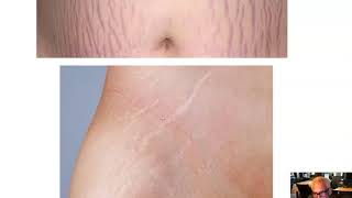 Ch 5 Part 2 Dermis Hypodermis and Hair