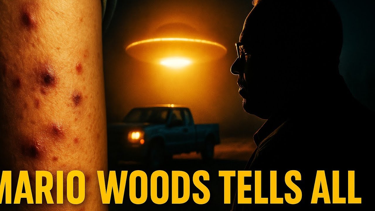Unexplained Pockmarks & Burns – The Aftermath of a UFO Encounter with Mario Woods.
