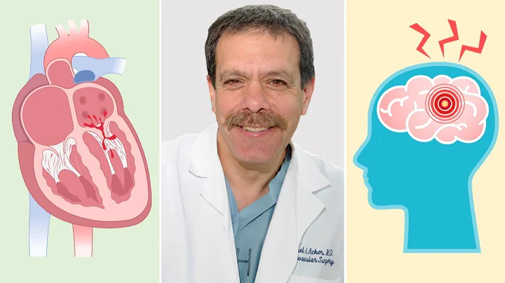 Surgeon Q&A: Mitral Valve Regurgitation & Stroke w...
