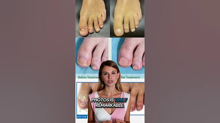 Podiatrist Foot Doctor Heel Pain Treatment Boca Raton Boynton West Palm Beach FL One Stop Foot...