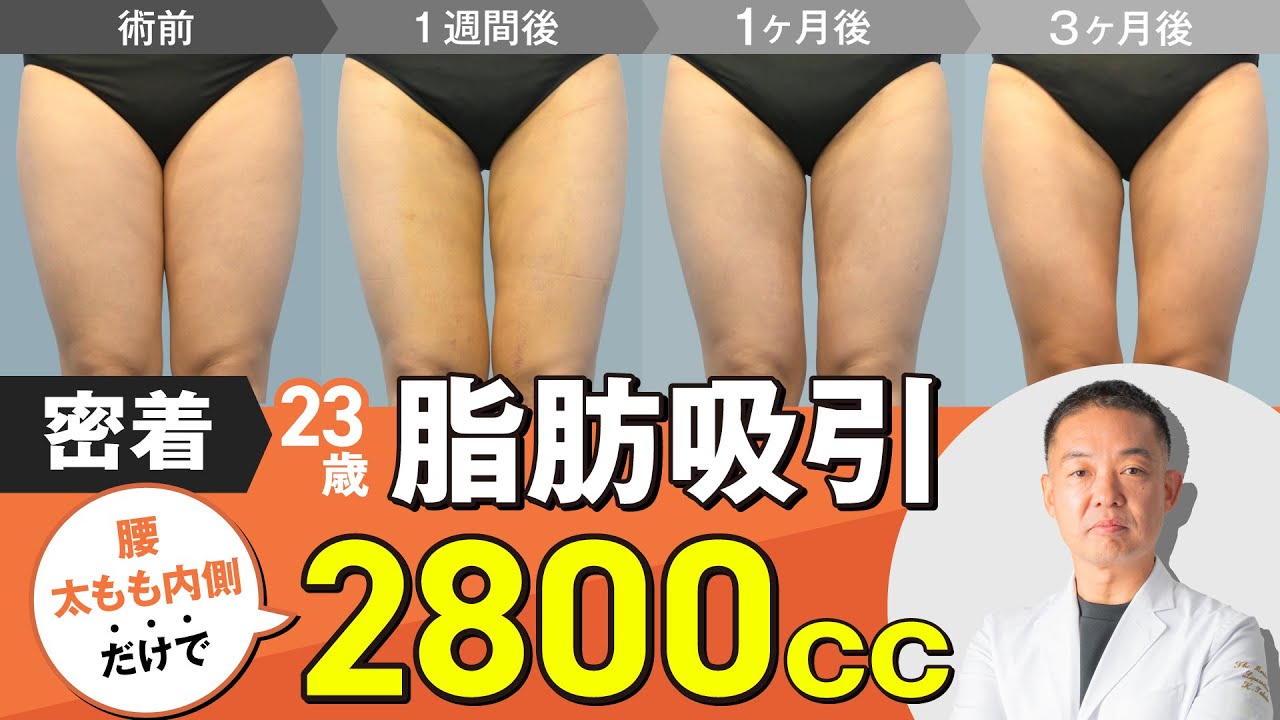 太もも脂肪吸引】23歳ダウンタイムが不安で決められなかったけど2800cc