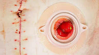 Ostomy Care Challenges: Obesity, Hernias, Skin Issues and More Webinar