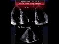 Myocardial strain/ While obtaining images #echocardiography #cardiologytraining #cardiology