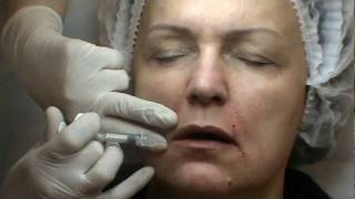 Princess Filler, Корнеаль, контурная пластика, семинар Princess Filler, Корнеаль, контурная пластика, семинар