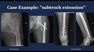 How I fix comminuted intertrochanteric femur fractures