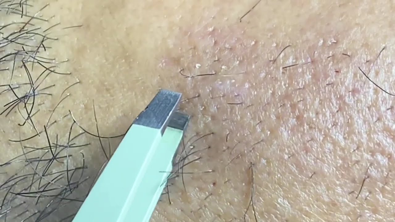 ASMR Plucking Beard Daily Routine Satisfying Hair Removal