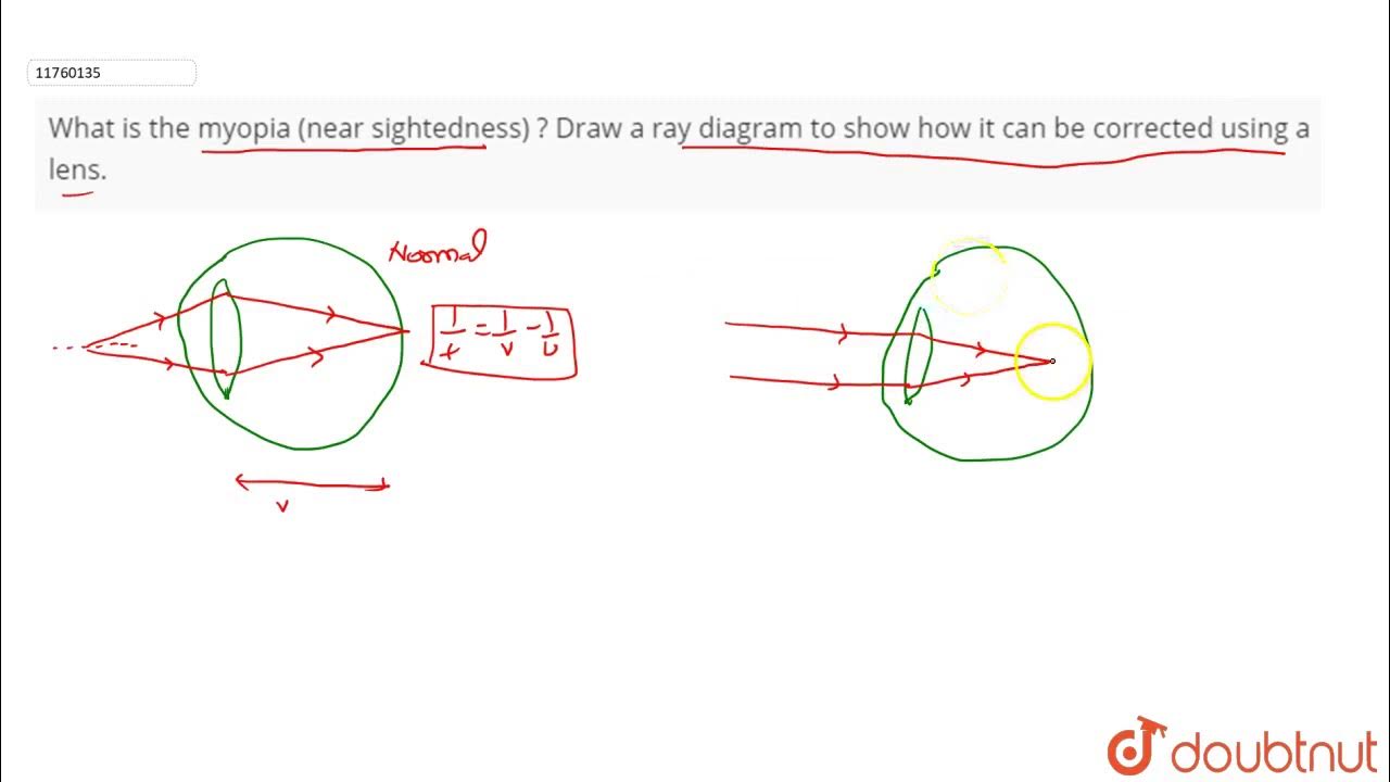 What is the myopia (near sightedness) ? Draw a ray diagram to show how