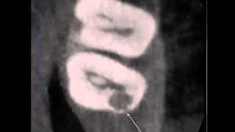 Interesting Resorption Case Described