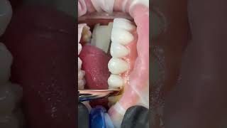 Before and After - Video by Dr Cristian Solano