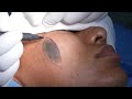 Giant Facial Mole Removal Permanently - Surgical Method