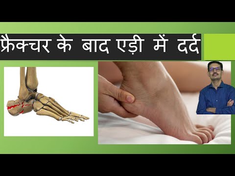 पोस्ट होने के ऐड में दर्द। (केल्के नियमावली) एड़ी /कैल्केनम फ्रैक्चर हिंदी