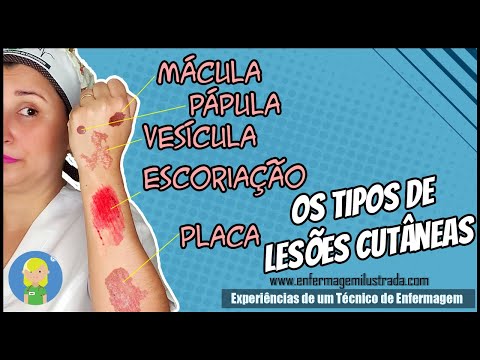 Vídeo: Lesões Cutâneas: Fotos, Causas, Tipos, Riscos, Diagnóstico E Tratamentos