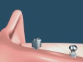 Over denture com implantes provisórios + o'ring