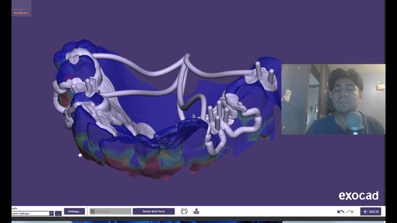 Diseñando PPR, EXOCAD