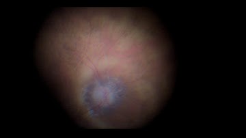 Alcon Ngenuity Ultra magnification mode  and Oculus LenZ