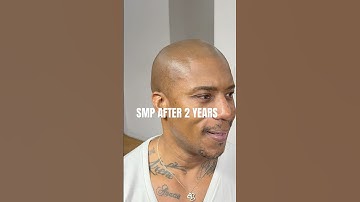 Scalp Micropigmentation After 2 years “healed results”