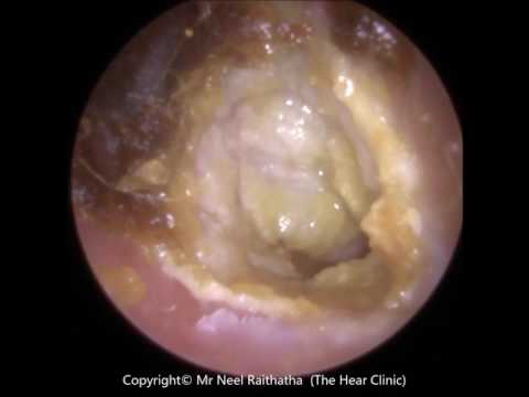 194:-eardrum-about-to-'explode'-after-blocked-ear-wax-removal-using-endoscopic-ear-microsuction