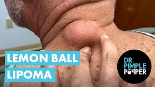 Dr Pimple Popper vs The Lemon Ball Lipoma