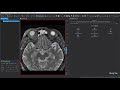 How to annotate dicom images using mitk  harrys vlog