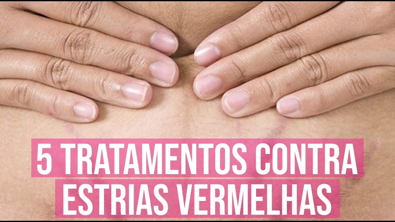 5 Melhores Tratamento para Estrias Vermelhas - YouTube