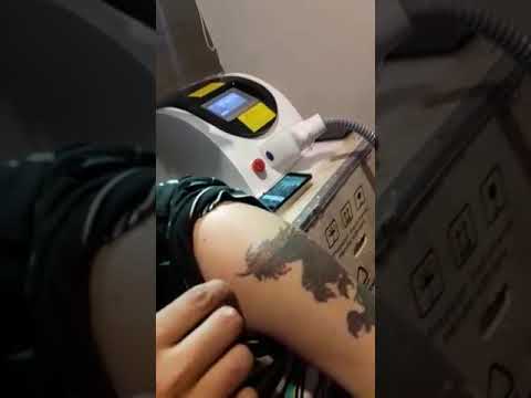 proses-penghapusan-tato-gratis-area-surabaya!