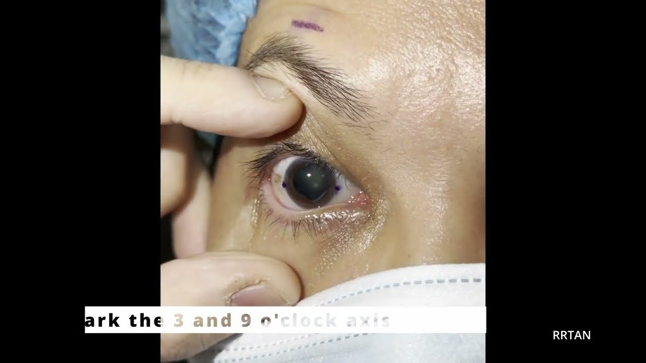 Manual Preop Toric Axis Marking