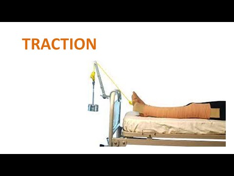 Traction: Principles, Types, Skin & Skeletal, Fixed & Sliding