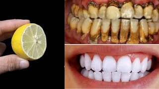 Secret that Dentists don&#39;t want you to know: Remove Tartar and Teeth Whitening in just 2 minutes