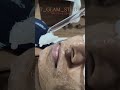 The ultimate secret to clear, glowing skin & the single best treatment for instant facial contouring