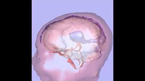 MRI of fetal brain