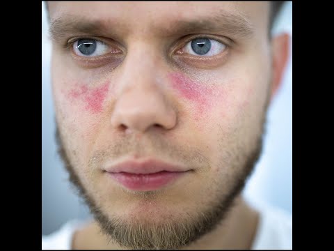 Video: Lupusul Pe Față - Cauze, Simptome, Diagnosticul și Tratamentul Lupusului Pe Față