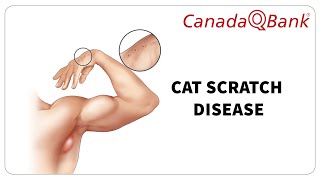 Cat Scratch Disease by CanadaQBank 838 views 2 weeks ago 6 minutes, 30 seconds