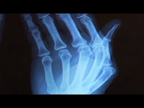rheumatoid arthritis 20 évesen