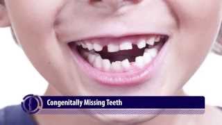 Congenitally Missing Teeth | Abnormalities in Tooth Quantity- 3