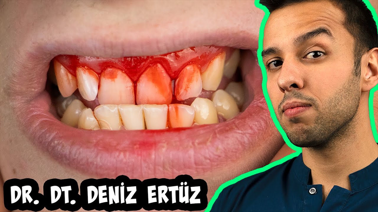 Процесс Ношения Брекетов | 