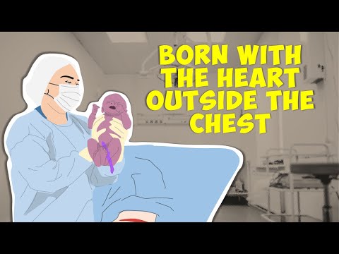 Ectopia Cordis | Born With the Heart Outside the Chest