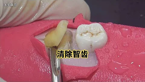 拔除智齿的全过程演示，全程解压，赶快来看 - 天天要闻