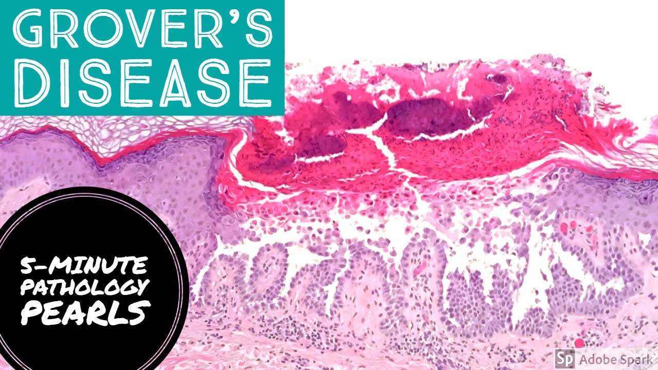 Grover's Disease (Transient Acantholytic Dermatosis) 5Minute Pathology Pearls YouTube
