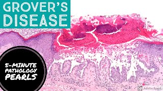 Grover's Disease (Transient Acantholytic Dermatosis): 5-Minute Pathology Pearls screenshot 1
