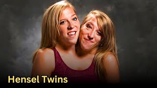 Doctors Share Sad News of Hensel Twins’ Surgery