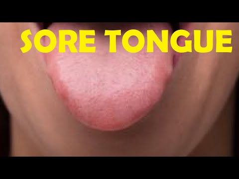 Video: 3 paprasti būdai, kaip išgydyti liežuvį suvalgius rūgštų saldainių