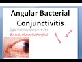 Ophthalmology 075 a Angular Bacterial Conjuntivitis Diplo Bacillary Moraxella Axenfeld angle foamy