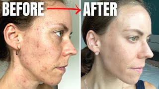 Plant Based Foods I Eat (and DON’T Eat) to Naturally Clear My Adult Acne! EASY VEGAN RECIPES by The Conscientious Eater 13,537 views 1 year ago 18 minutes