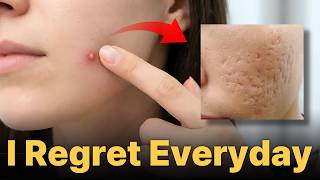 How to Treat Acne Without Scarring