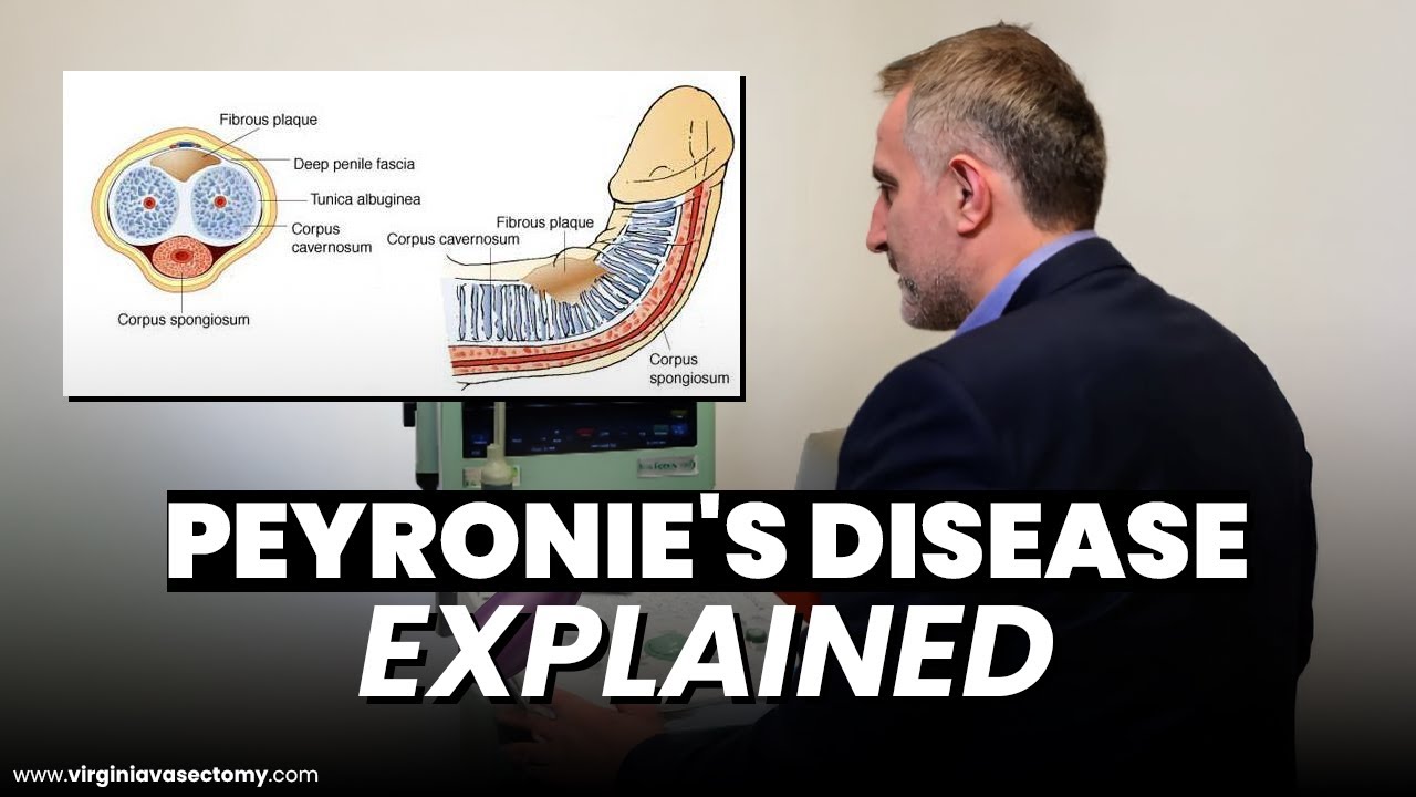 What Is Peyronie's Disease