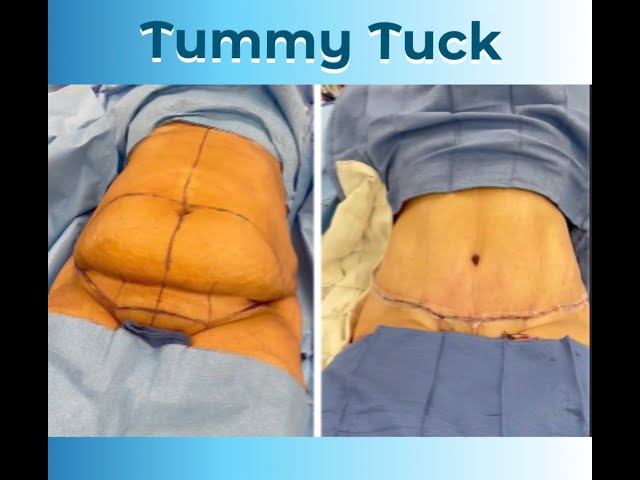 Tummy Tuck Technique